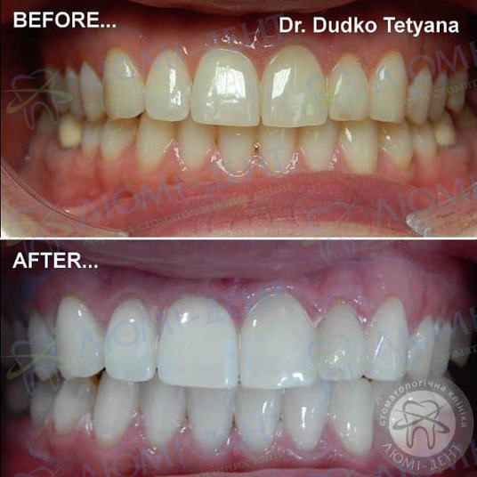 Фото Відбілювання Magic Smile Київ Люмі-Дент